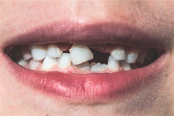 梦见坏牙掉了是什么意思 梦见坏牙掉了是什么意思