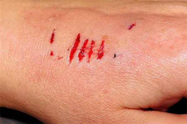 梦见被狗抓伤是什么意思 梦见被狗抓伤是什么意思