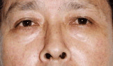 鼻孔仰露主难有积聚