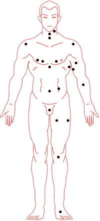 痣的位置与命运图:02、痣相吉凶速查 点痣必读要诀