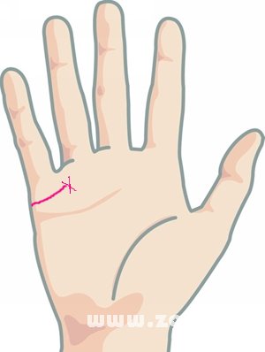 婚姻线末端出现「Ｘ」纹
