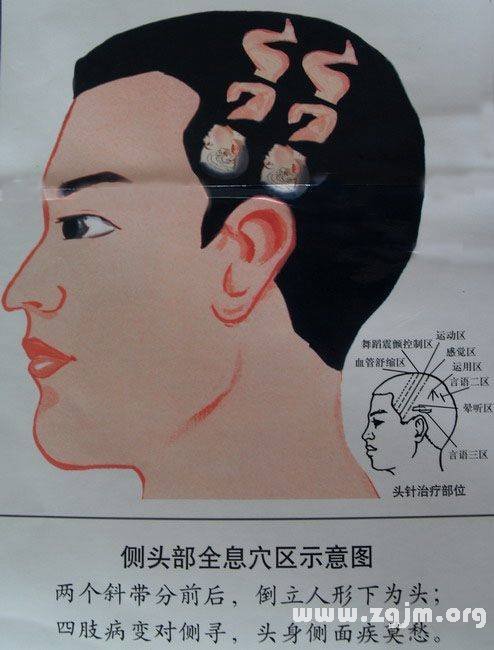 侧头全息穴位示意图
