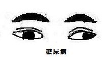 内斜视